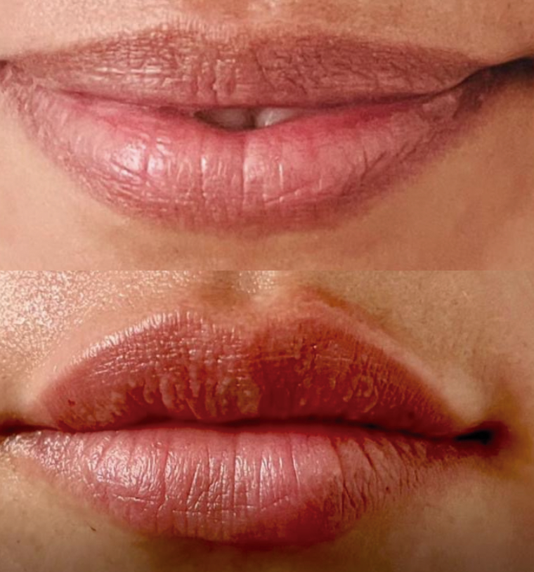 Aumento de labios