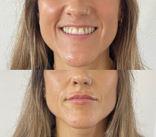 Aumento de labios