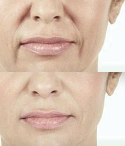 Líneas de marioneta