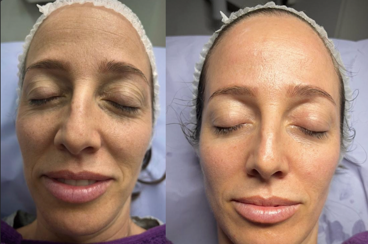 Hidrafacial