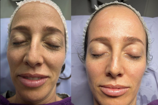 Hidrafacial