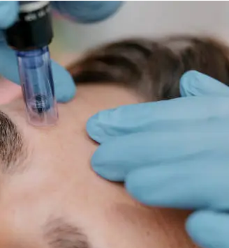 Dermapen Microneedling