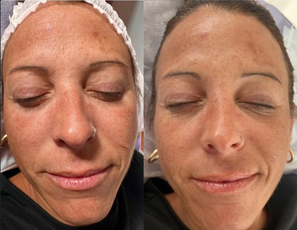 Hidrafacial