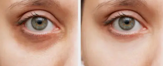 Corrección de ojeras